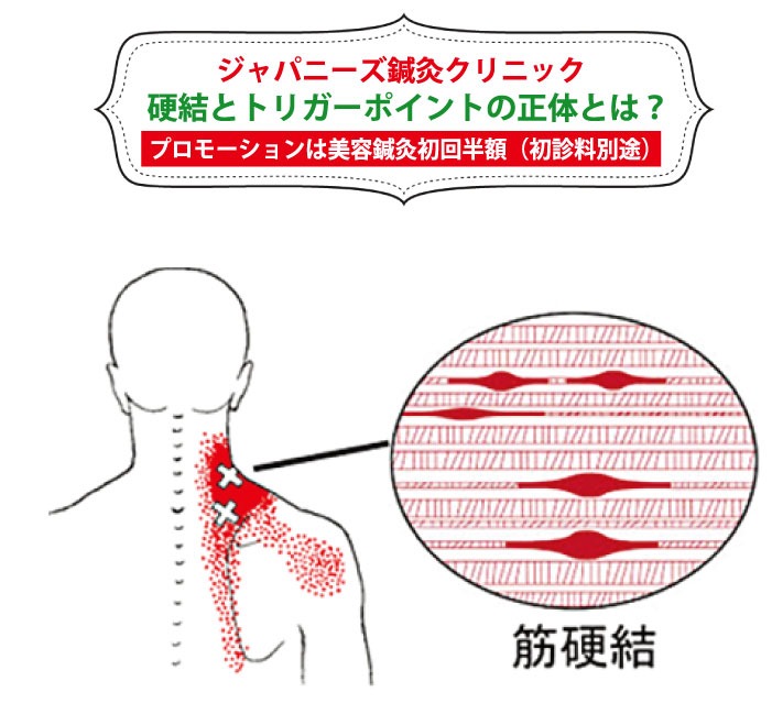 硬結とトリガーポイントの正体とは タイ バンコク タイ自由ランド