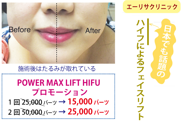 「整形・美容のエーリサクリニック」ハイフによるフェイスリフト