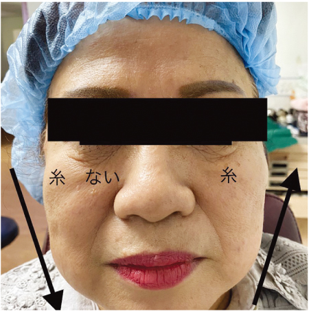 ミラクリフト施術中の女性