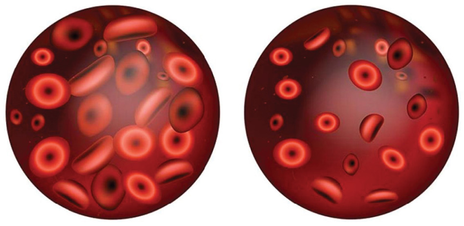 健康で正常な血液（左）は血球が多く、再生不良性貧血（右）は血球が少ない