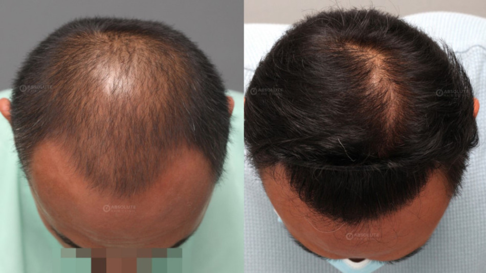 写真左が植毛手術前で写真右が植毛移植後