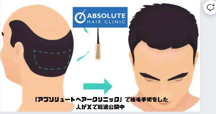 「アブソリュートヘアークリニック」で植毛手術をした人がXで経過公開中