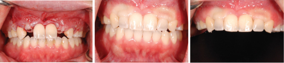 失われた永久歯もインプラント治療により違和感なく自然な自分の歯を取り戻すことができます