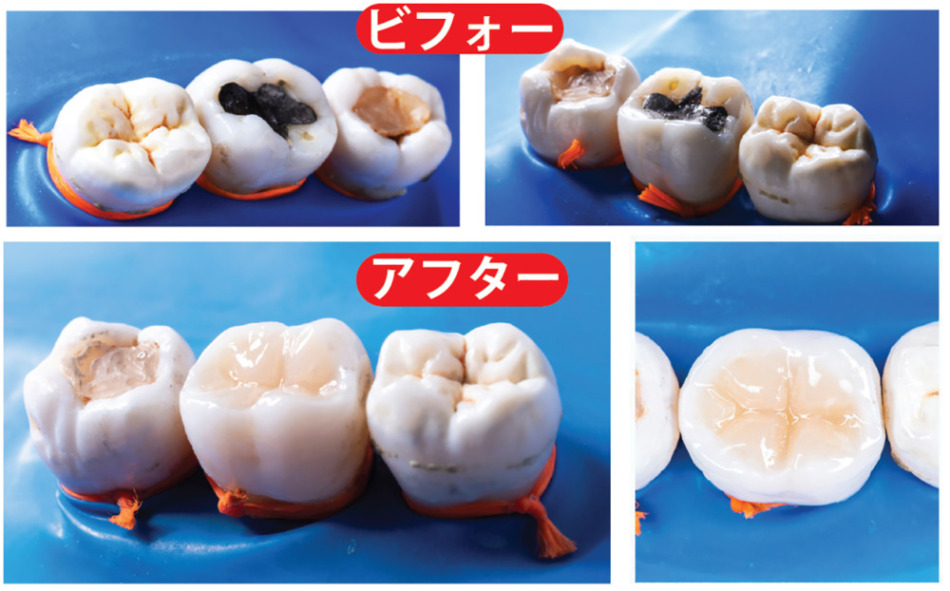 「JPグリーンデンタルクリニック」歯と同じ色の詰め物で美しい歯を取り戻す