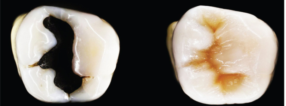 「JPグリーンデンタルクリニック」自然な歯の色の詰め物ができます